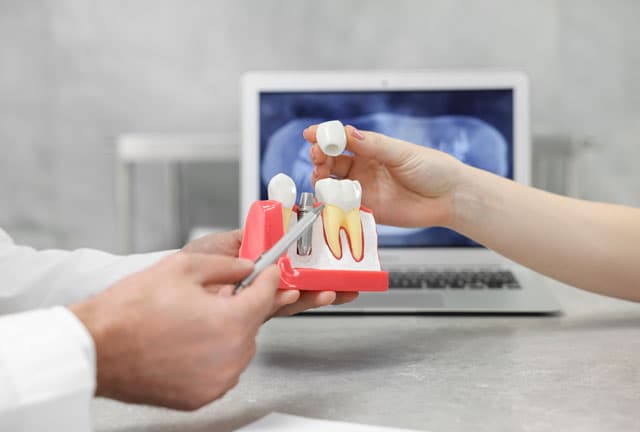 Implantes dentales