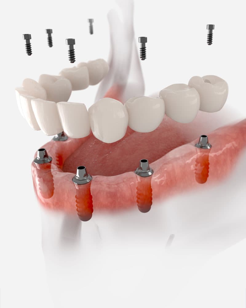 prótesis dentales