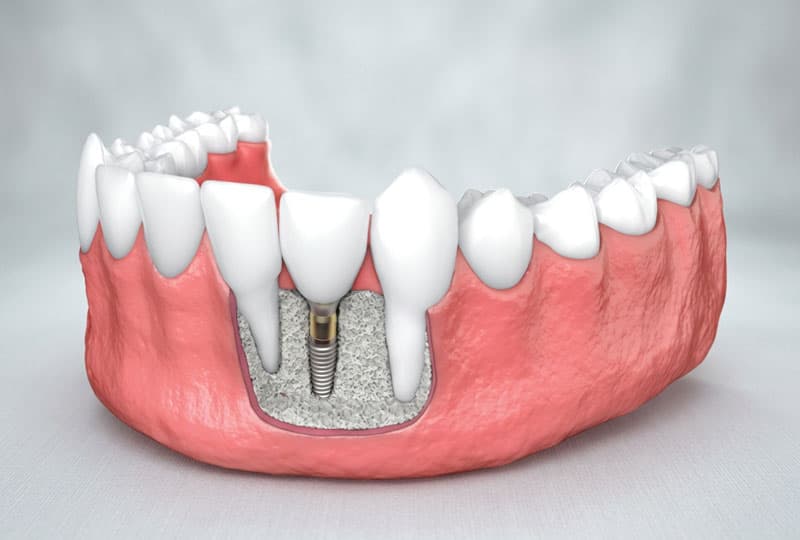 Regeneración ósea guiada para implantes en Alcorcón