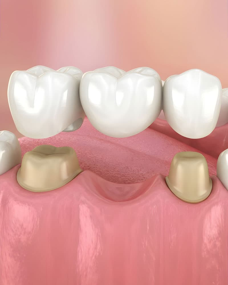 implantología dental en Alcorcón