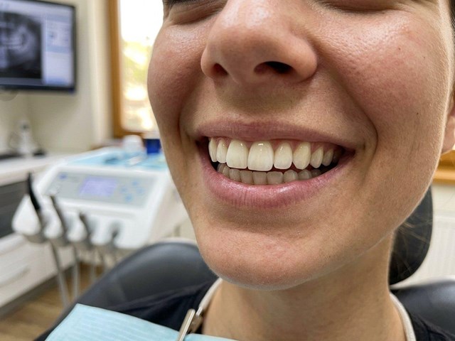 Implantes dentales unitarios en Alcorcón