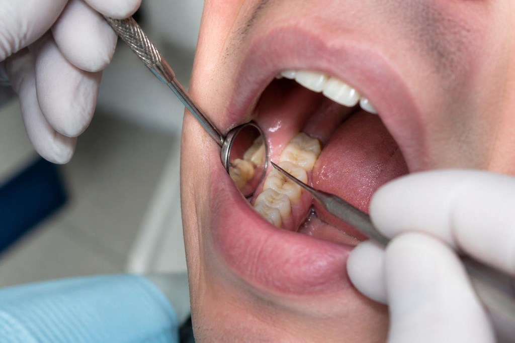 Foto 1 Tratamiento contra caries dentales en Alcorcón