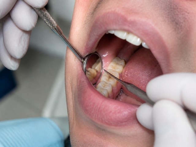 Tratamiento contra caries dentales en Alcorcón